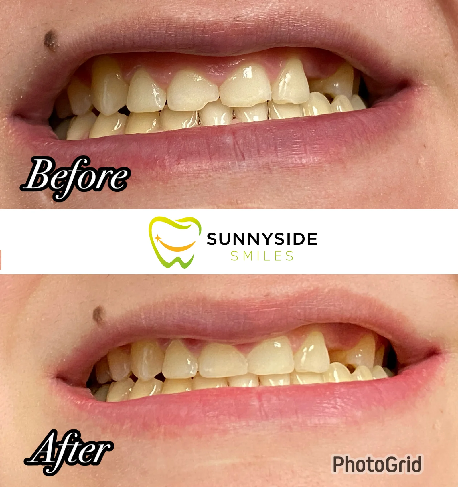 Before and after chipped front tooth repair at Sunnyside Smiles