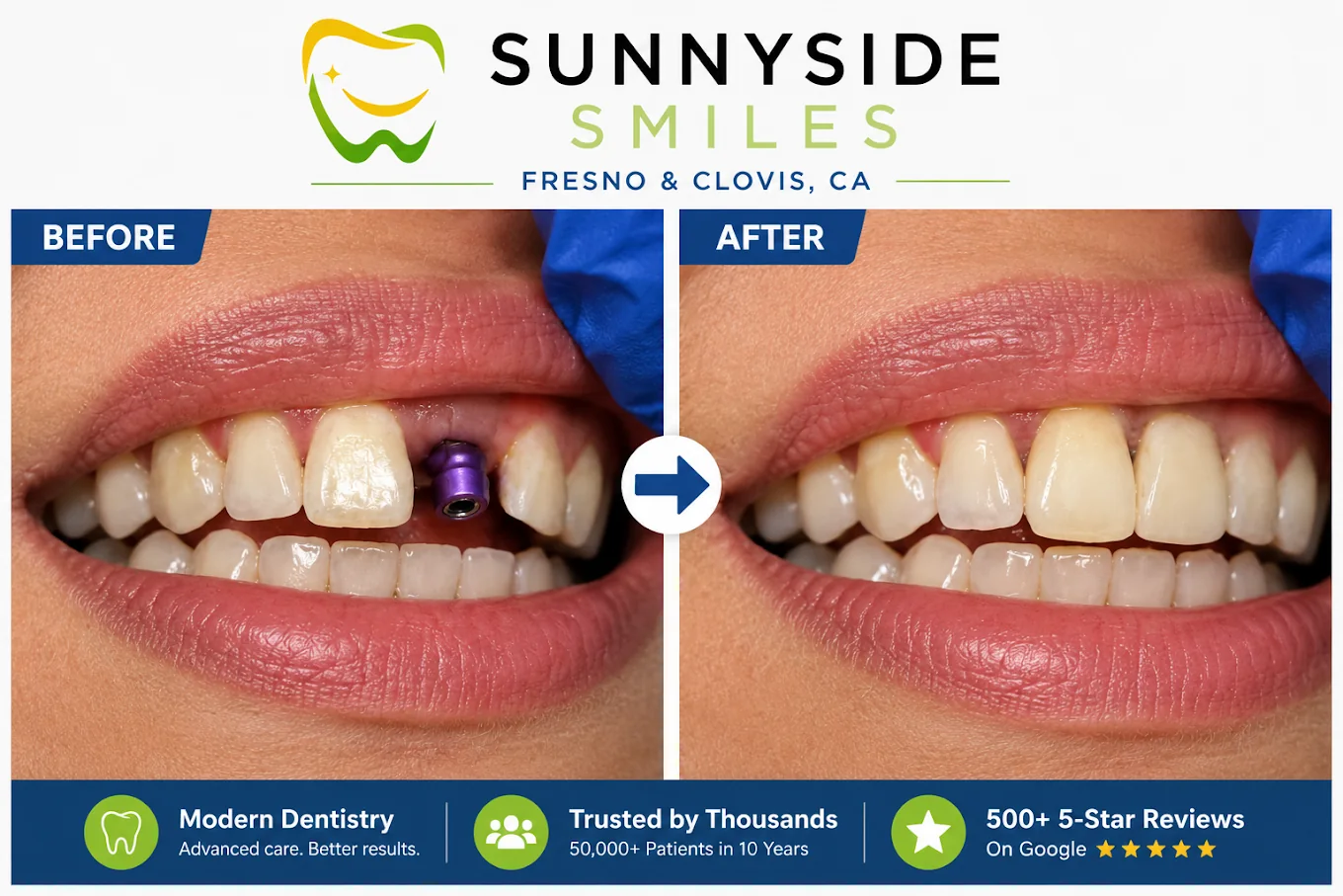 Before and after dental implant replacement for a missing front tooth at Sunnyside Smiles