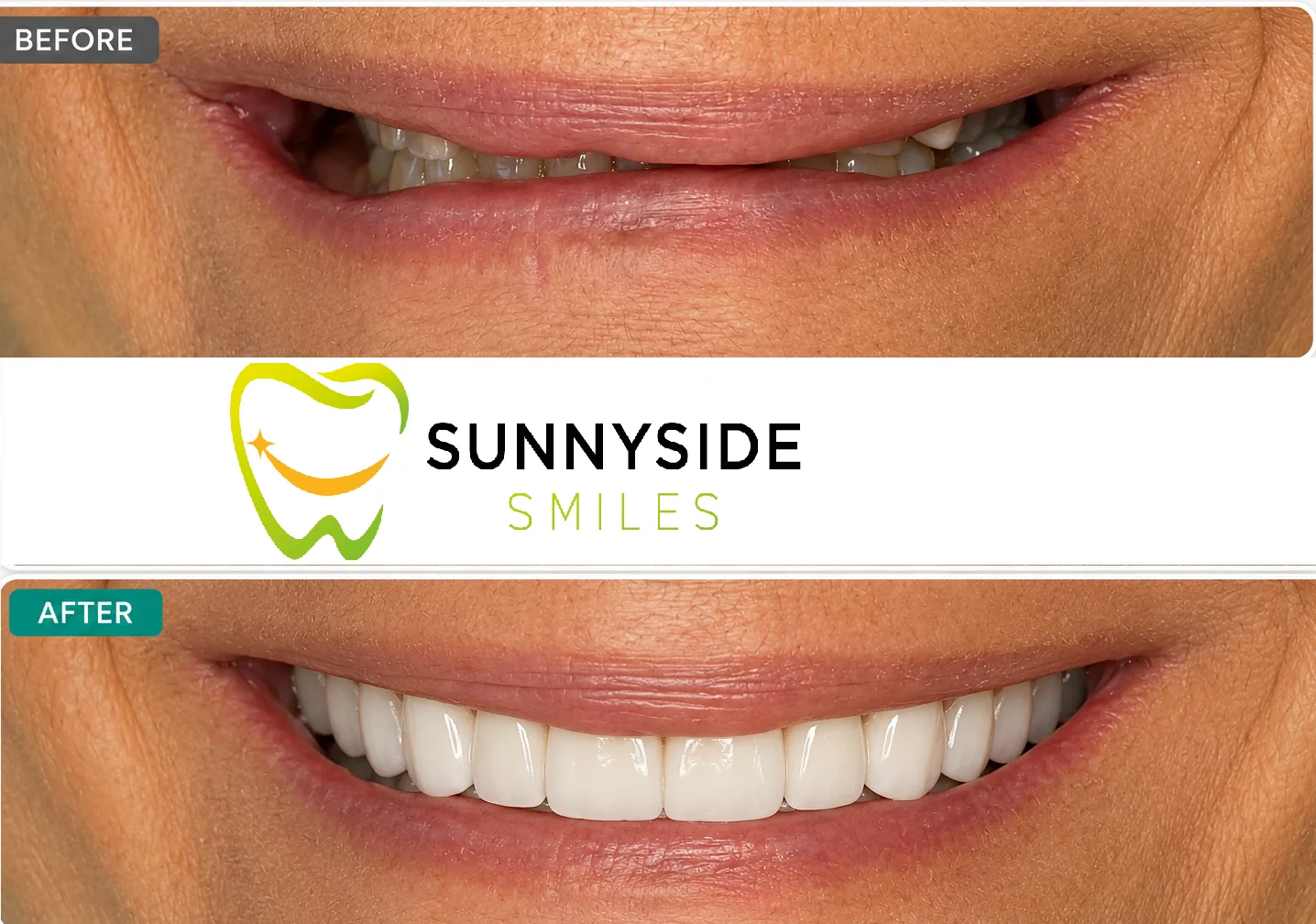 Before and after smile makeover with brighter, fuller front teeth at Sunnyside Smiles