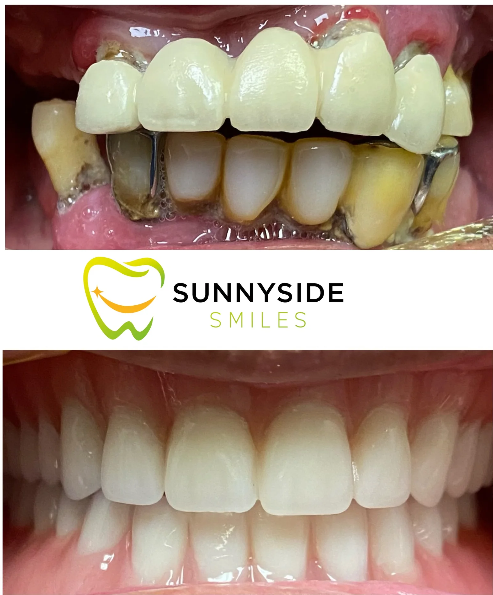 Before and after smile makeover with restored upper front teeth at Sunnyside Smiles