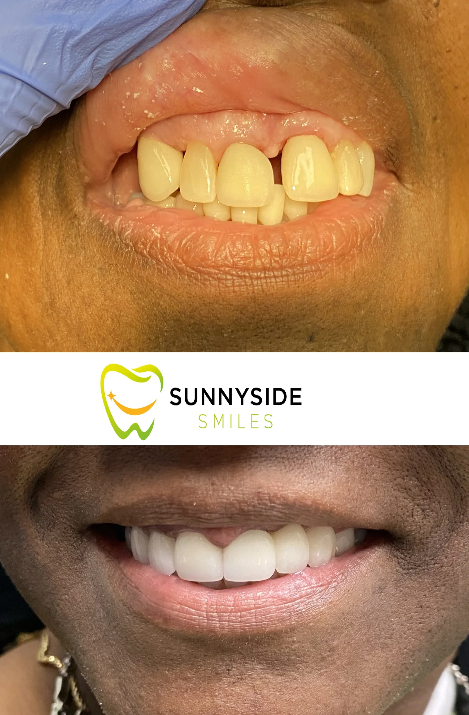 Before and after smile makeover with improved upper front teeth at Sunnyside Smiles