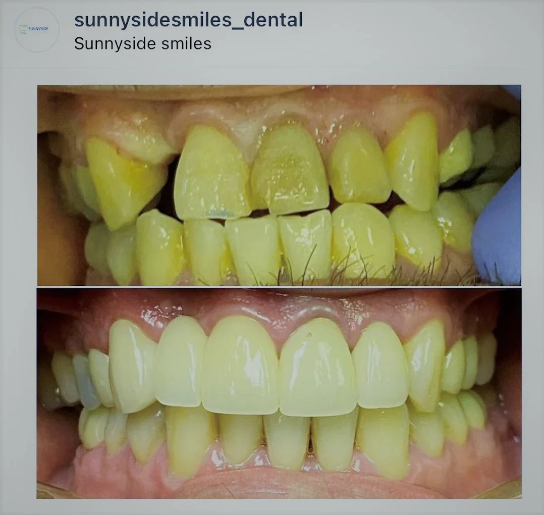 Before and after smile makeover with improved alignment and front tooth shape at Sunnyside Smiles